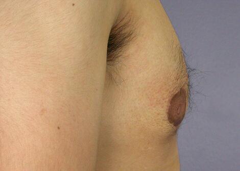 Breast Reduction (for Men) Before & After Image