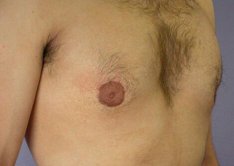 Breast Reduction (for Men) Before & After Image