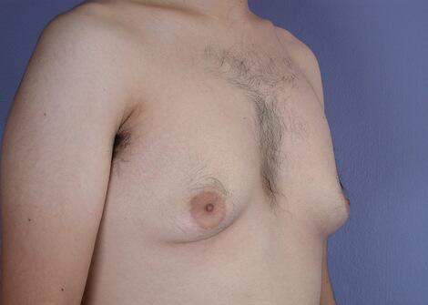 Breast Reduction (for Men) Before & After Image