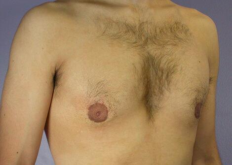 Breast Reduction (for Men) Before & After Image