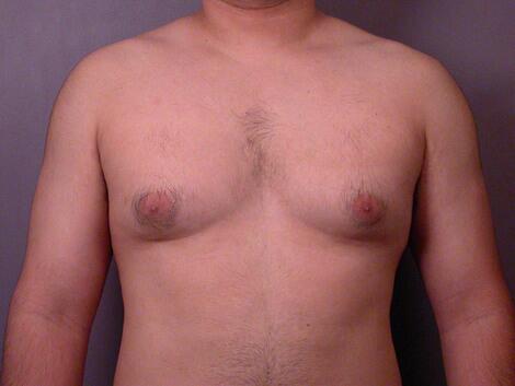 Breast Reduction (for Men) Before & After Image