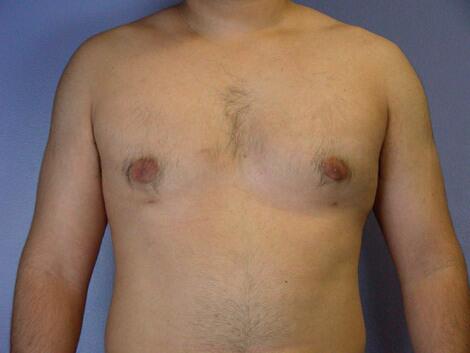 Breast Reduction (for Men) Before & After Image