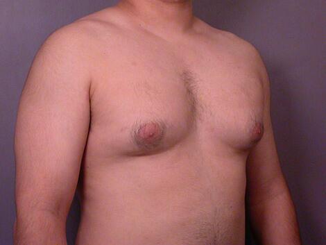 Breast Reduction (for Men) Before & After Image