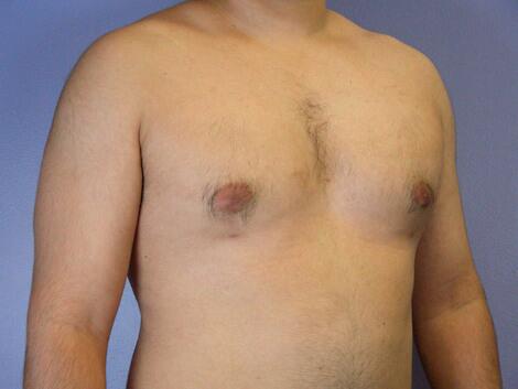 Breast Reduction (for Men) Before & After Image