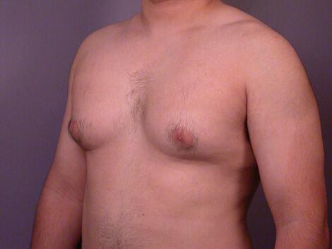 Breast Reduction (for Men) Before & After Image