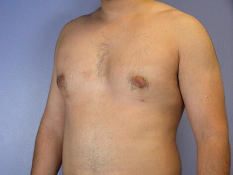 Breast Reduction (for Men) Before & After Image