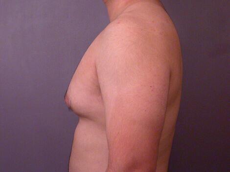 Breast Reduction (for Men) Before & After Image