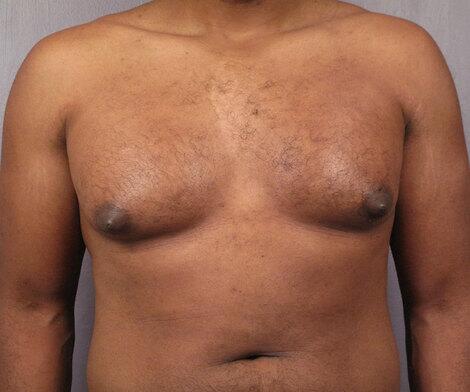 Breast Reduction (for Men) Before & After Image