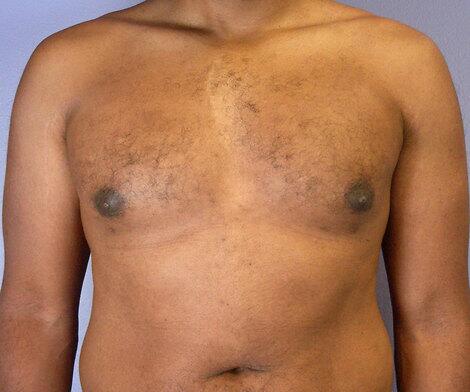 Breast Reduction (for Men) Before & After Image