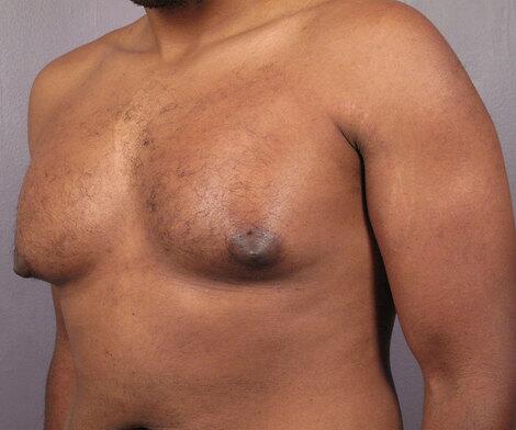 Breast Reduction (for Men) Before & After Image