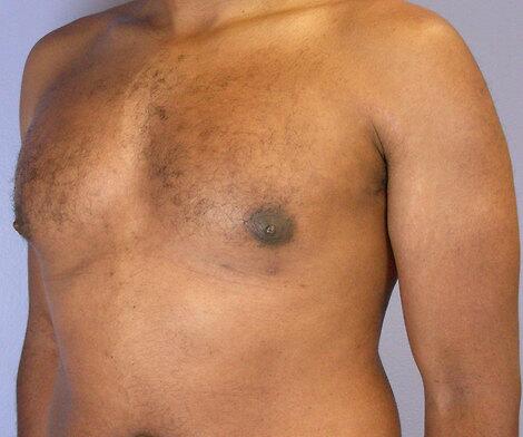 Breast Reduction (for Men) Before & After Image