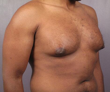 Breast Reduction (for Men) Before & After Image