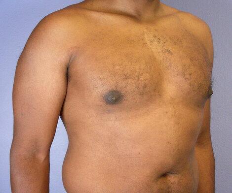 Breast Reduction (for Men) Before & After Image