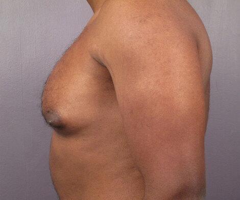 Breast Reduction (for Men) Before & After Image