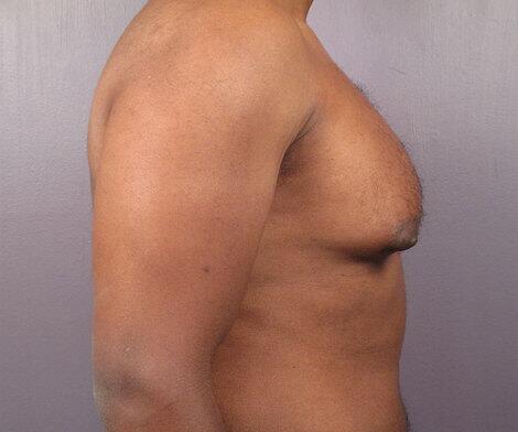 Breast Reduction (for Men) Before & After Image