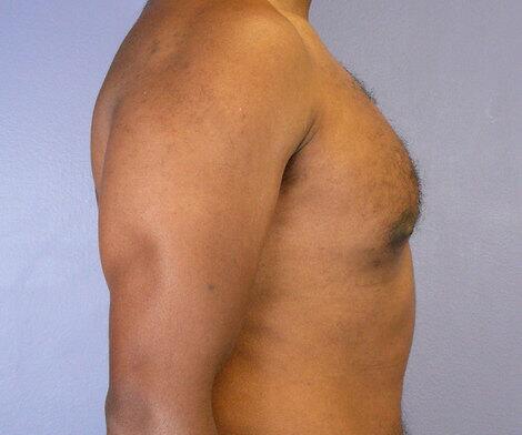 Breast Reduction (for Men) Before & After Image