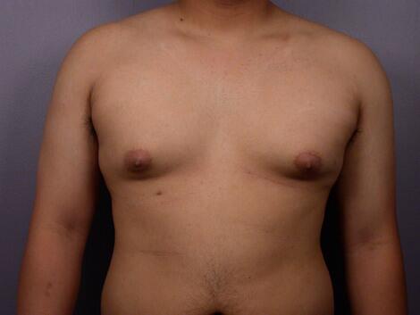 Breast Reduction (for Men) Before & After Image