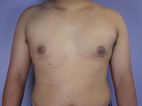 Breast Reduction (for Men) Before & After Image