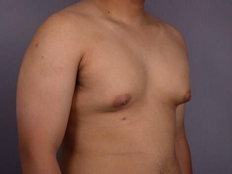 Breast Reduction (for Men) Before & After Image