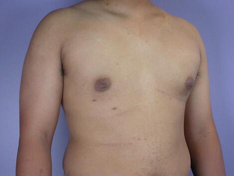 Breast Reduction (for Men) Before & After Image