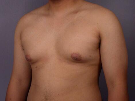 Breast Reduction (for Men) Before & After Image