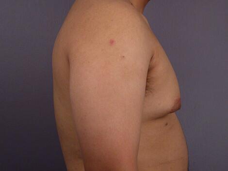 Breast Reduction (for Men) Before & After Image