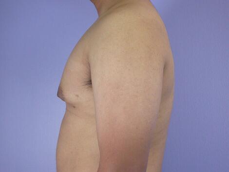 Breast Reduction (for Men) Before & After Image