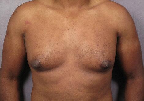 Breast Reduction (for Men) Before & After Image