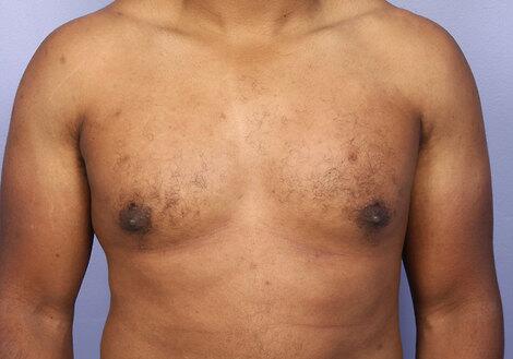 Breast Reduction (for Men) Before & After Image