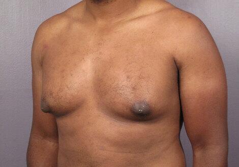 Breast Reduction (for Men) Before & After Image