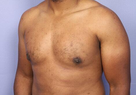 Breast Reduction (for Men) Before & After Image