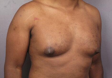 Breast Reduction (for Men) Before & After Image