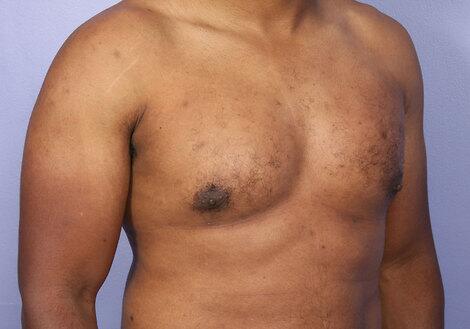 Breast Reduction (for Men) Before & After Image