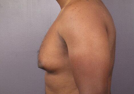 Breast Reduction (for Men) Before & After Image