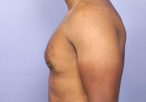 Breast Reduction (for Men) Before & After Image