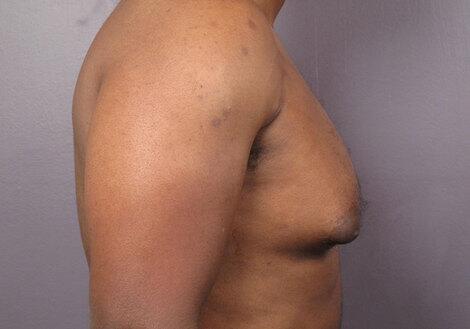 Breast Reduction (for Men) Before & After Image