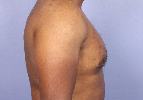 Breast Reduction (for Men) Before & After Image