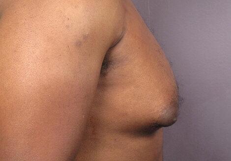 Breast Reduction (for Men) Before & After Image