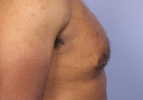 Breast Reduction (for Men) Before & After Image