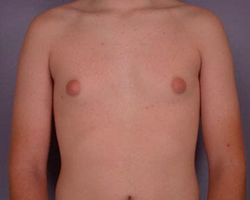 Breast Reduction (for Men) Before & After Image