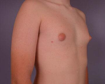 Breast Reduction (for Men) Before & After Image