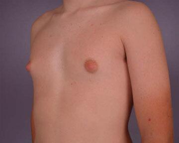 Breast Reduction (for Men) Before & After Image