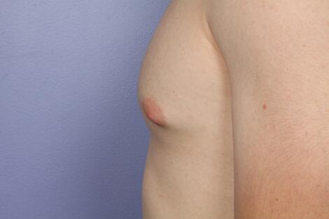 Breast Reduction (for Men) Before & After Image