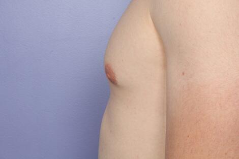 Breast Reduction (for Men) Before & After Image