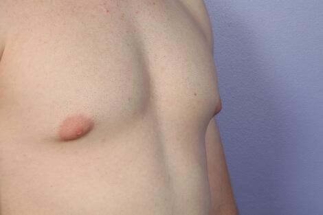 Breast Reduction (for Men) Before & After Image