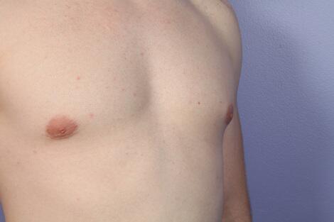 Breast Reduction (for Men) Before & After Image