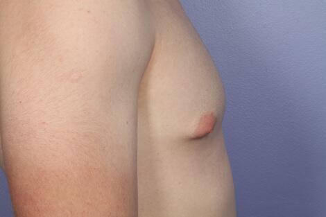 Breast Reduction (for Men) Before & After Image