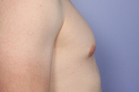 Breast Reduction (for Men) Before & After Image