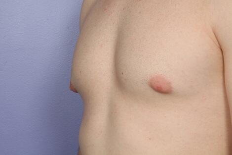 Breast Reduction (for Men) Before & After Image