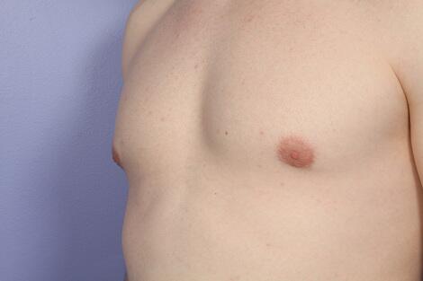 Breast Reduction (for Men) Before & After Image